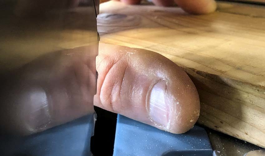 Lose a Finger? Grab a Toe! | Michigan Man Recounts Woodworking Injury