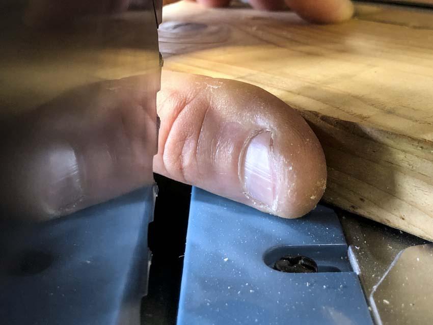 Lose a Finger? Grab a Toe! | Michigan Man Recounts Woodworking Injury